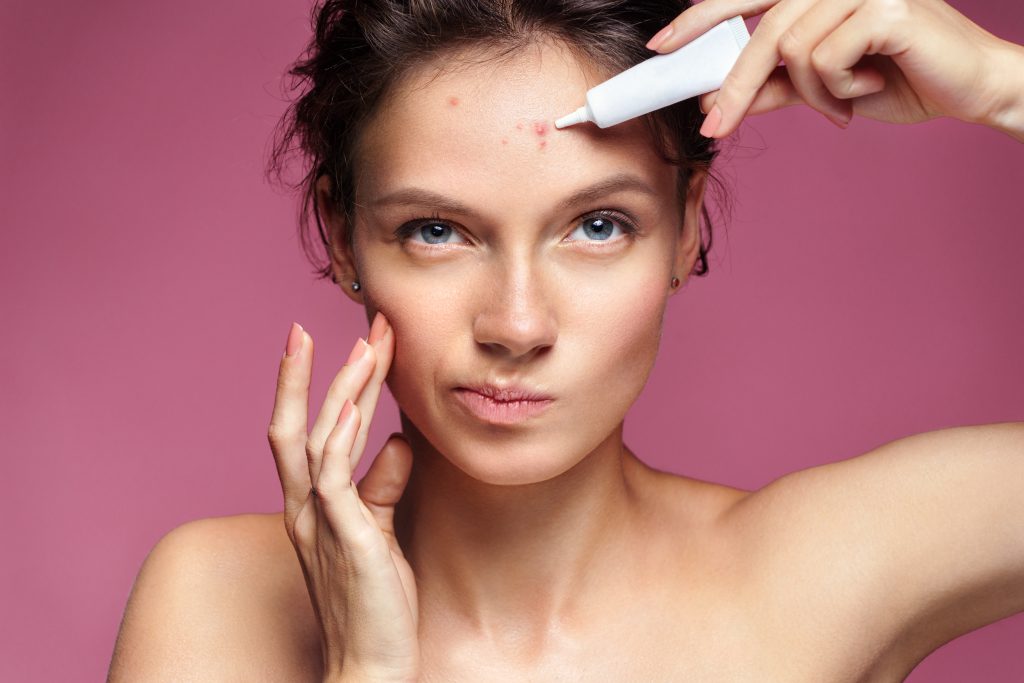 Scowling girl pointing at her acne and applying treatment cream.