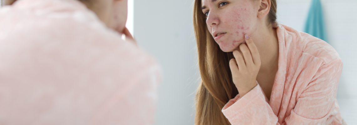 When To See A Doctor About Acne