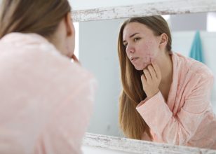 When To See A Doctor About Acne