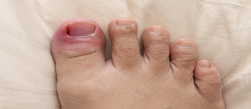 Best Podiatrist in Murwillumbah