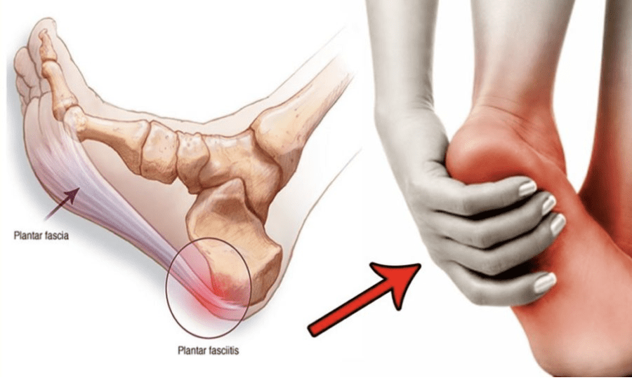 3 Ways to Get Rid of Plantar Fasciitis Without Drugs or Surgery