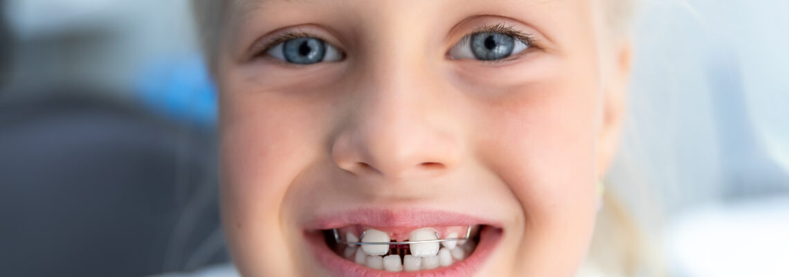 How Teeth Gaps Affect Your Overall Health