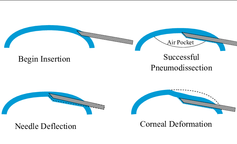 Deep Anterior 