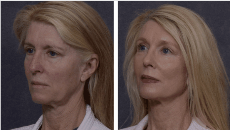 Eyelid surgery