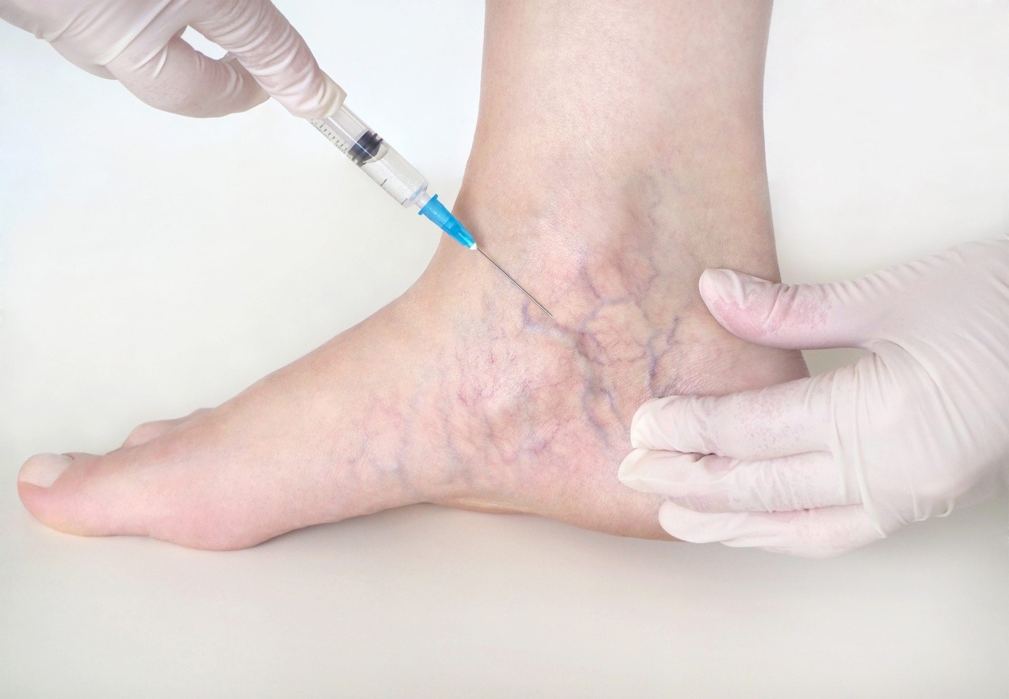 existing varicose veins