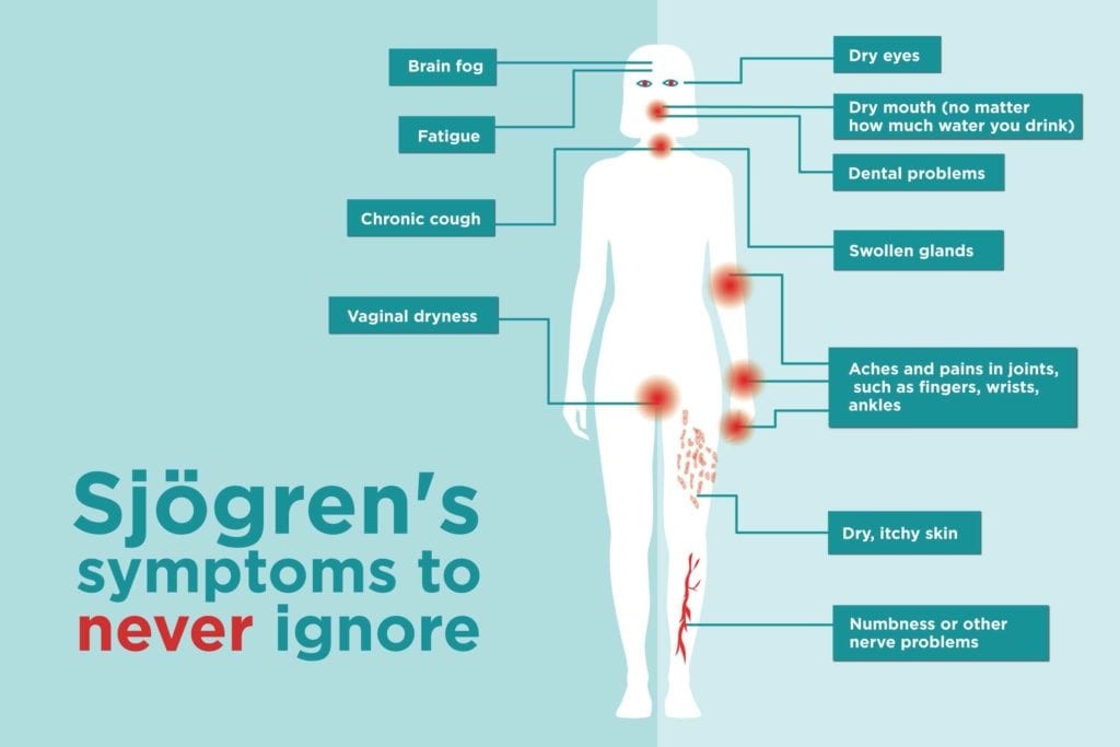 Sjögren’s syndrome