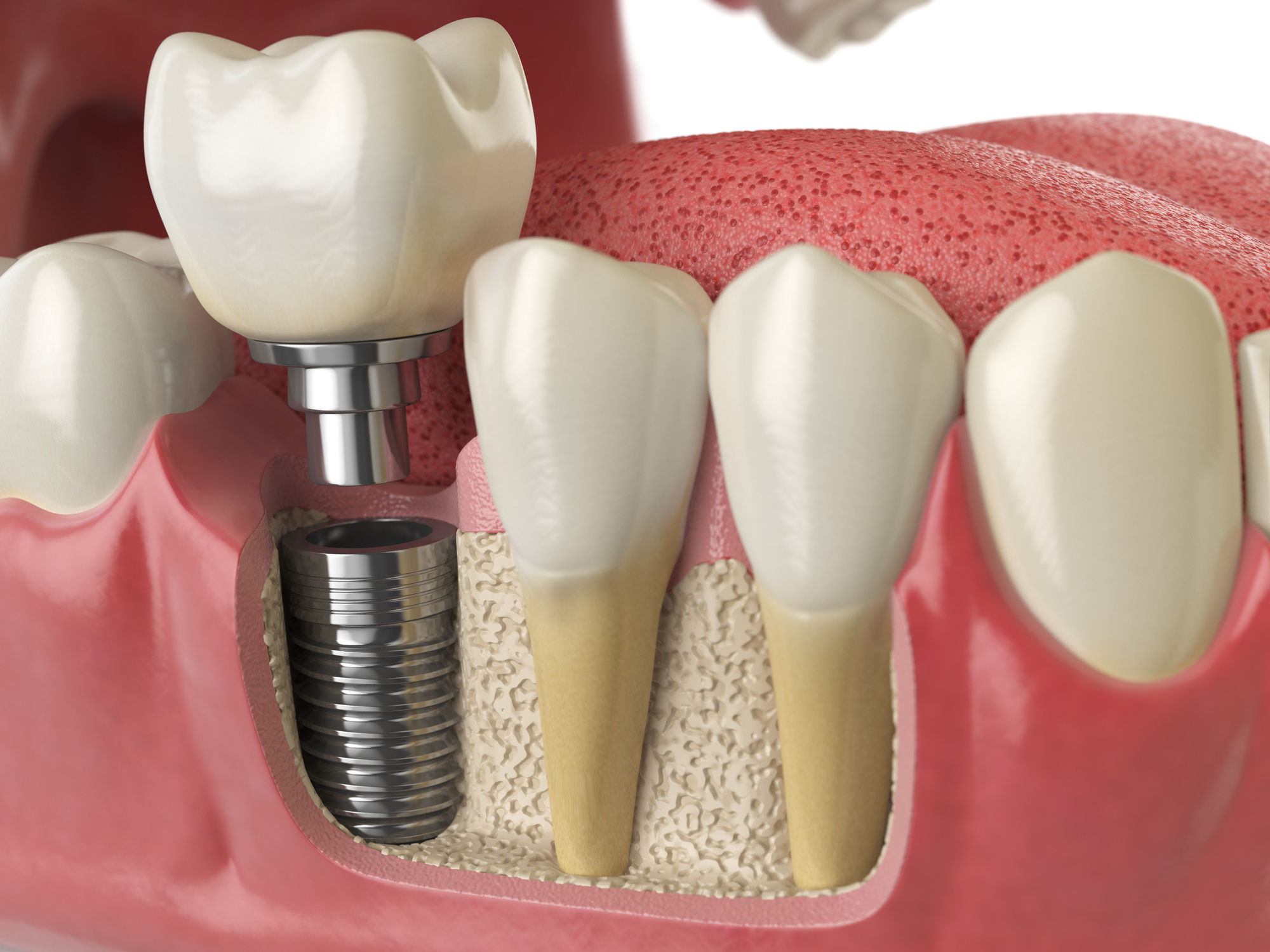 Tooth Implantation