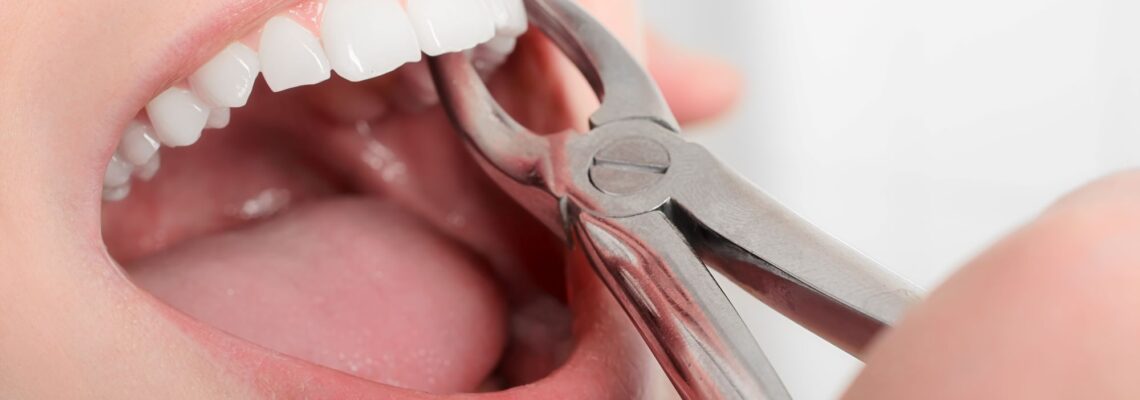 8 Things To Do Before And After A Tooth Extraction