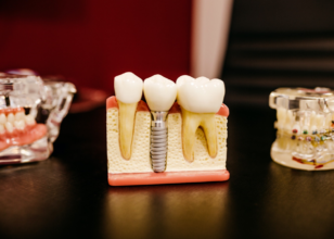 Top Signs That You May Need Dental Implants