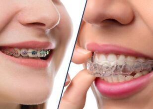 Why Invisalign is not enough