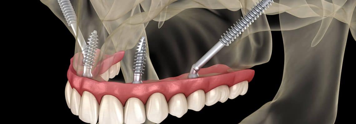 Revive Your Smile: Zygomatic Implant Treatment