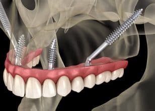 Revive Your Smile: Zygomatic Implant Treatment