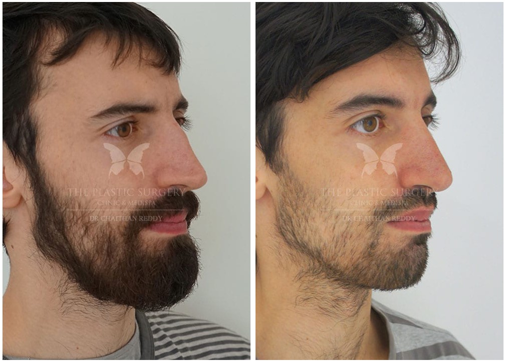 Rhinoplasty in Sydney: Sculpting Confidence with Precision